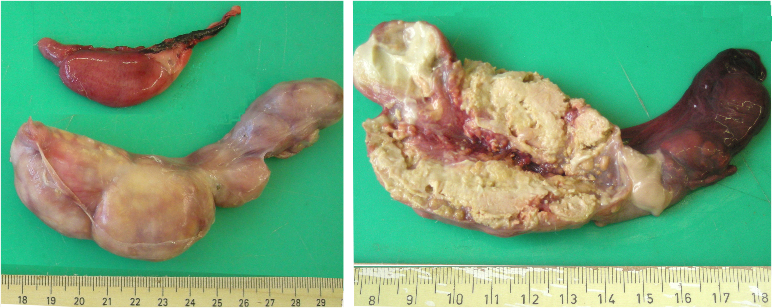 Hodenschwellung bei Brucellose 